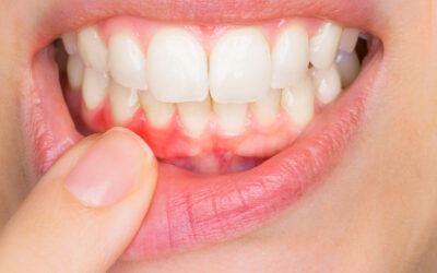 Si te sangran las encías acude a tu dentista.